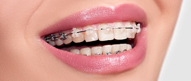 Braces, Toothworks Dental Clinics